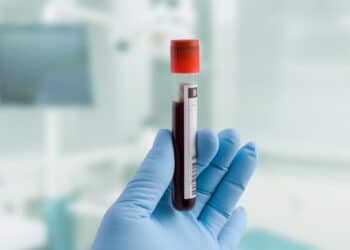 Person with a medical glove holding up a vial containing a blood sample