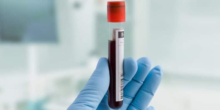 Person with a medical glove holding up a vial containing a blood sample