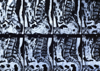 Spinal Surgery Whistleblower