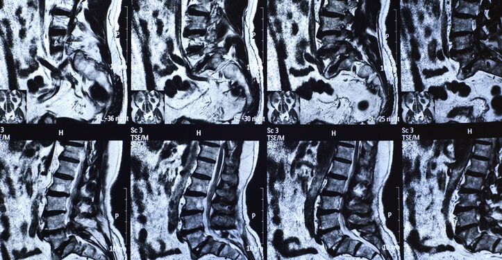 Spinal Surgery Whistleblower